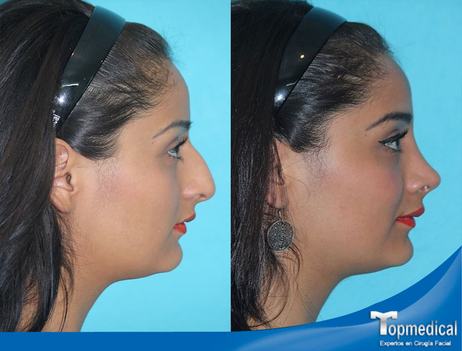 Cirugía de Nariz (Rinoplastia) en Topmedical.